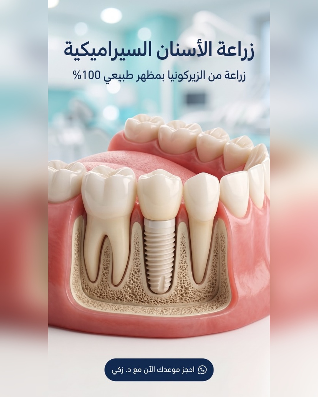 نموذج تشريحي ثلاثي الأبعاد لزرعة الزيركونيا في الفك